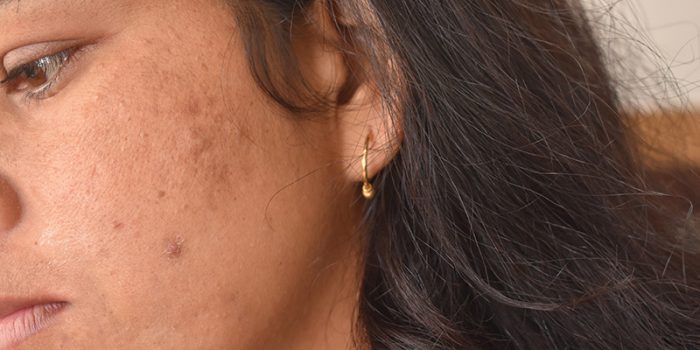 Komplikace permanentního make-upu na mastné pleti